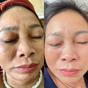 Làn da trước và sau khi điều trị nám tại Zikii