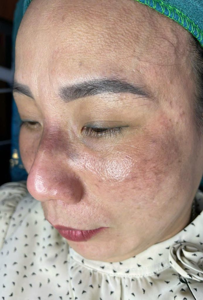 Nám da và cách điều trị