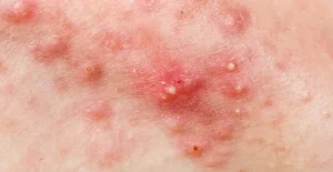 Serum mụn ZIKII có khả năng điều trị nhiều loại mụn khác nhau