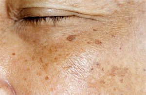 Có rất nhiều nguyên nhân dẫn đến tình trạng đốm nâu trên da