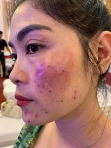 Sau khi điều trị nám bằng laser hoặc các phương pháp chuyên sâu, làn da thường trở nên nhạy cảm, mỏng yếu và dễ bị kích ứng
