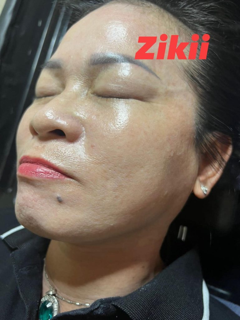 Bạn cần 4-8 tuần để thấy kết quả rõ rệt của kem trị nám